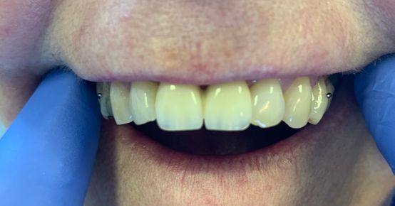Newly fitted dentures