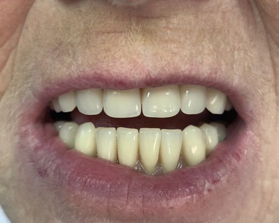 After, more realistic upper jaw dentures