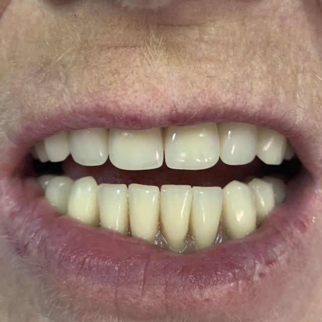 After, more realistic upper jaw dentures