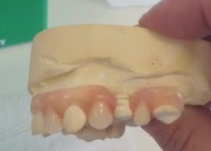 Flexi dentures in a mould
