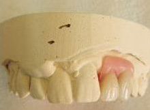Partial dentures inside a mould