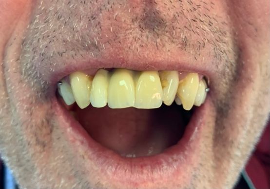 After, natural looking irregular dentures 