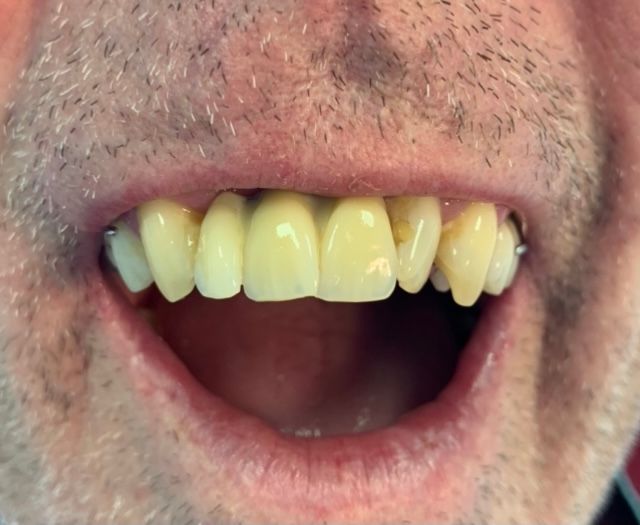 After, natural looking irregular dentures 