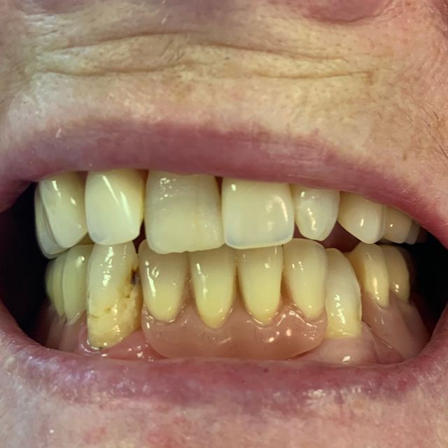 After: Parital dentures on lower jaw