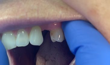  removable flexi partials