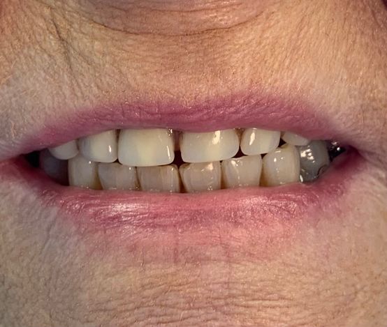 Before, older damaged dentures 