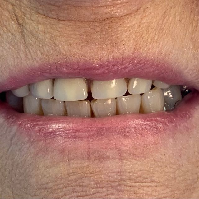 Before, older damaged dentures 