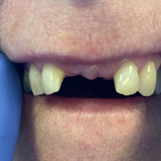 Before & After Walkinstown Dental Studio Dublin