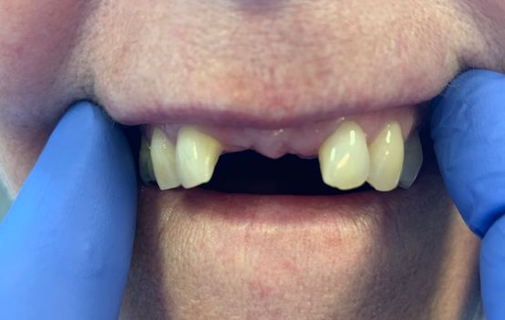  Palate free partial