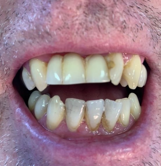 Before, irregular teeth dentures that are damaged