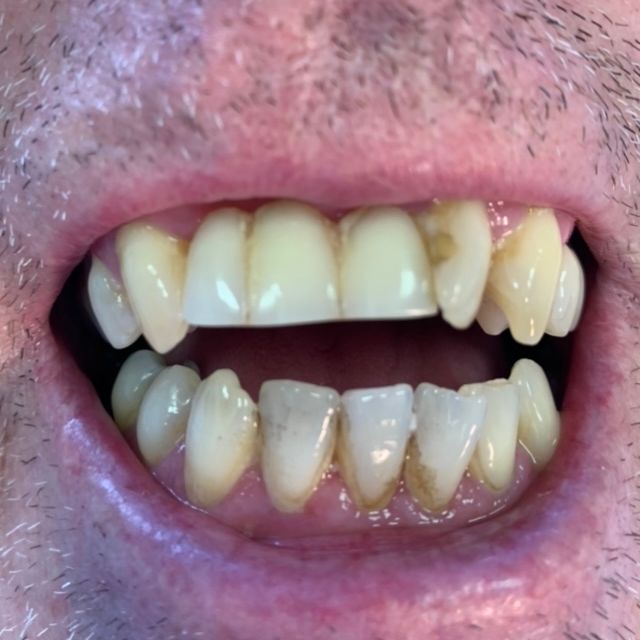 Before, irregular teeth dentures that are damaged