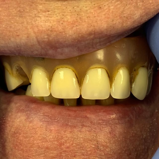 Before: Old unrealistic dentures 