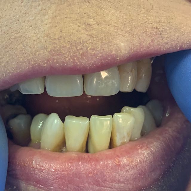 After: Missing teeth replaced with partial dentures 