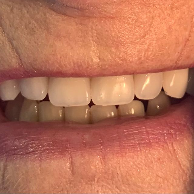 After: Clean new dentures