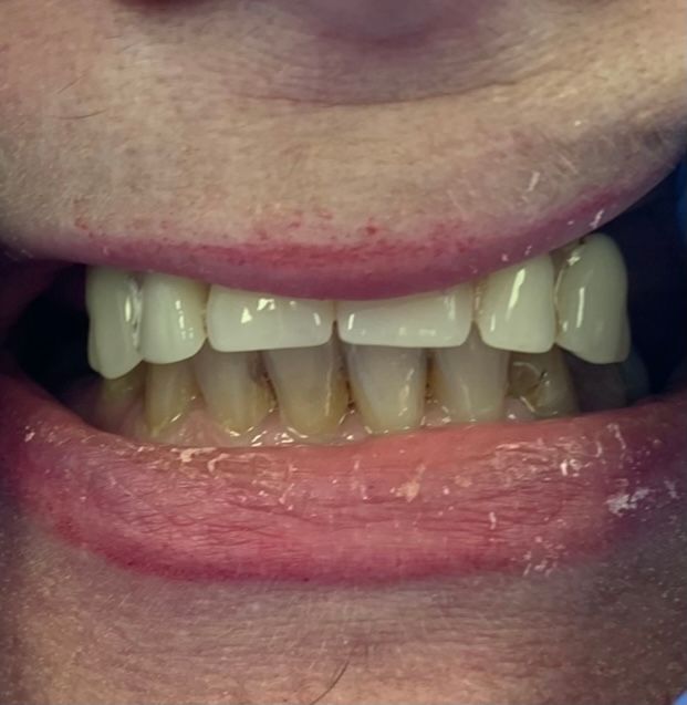 Before, yellowing upper dentures