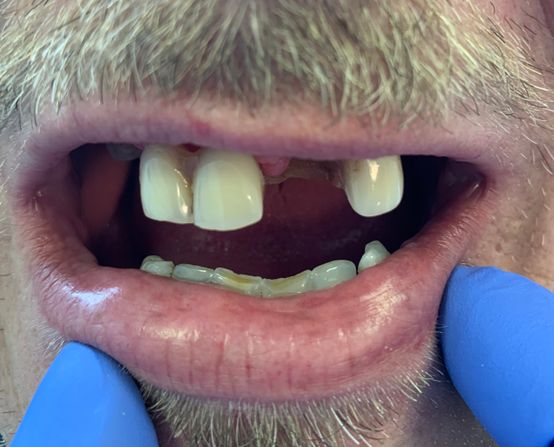 Before, missing teeth 
