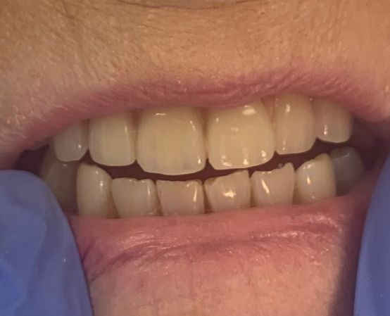 After, better dentures and more realistic 