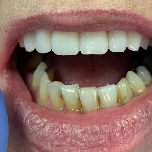 After, brighter upper jaw dentures 