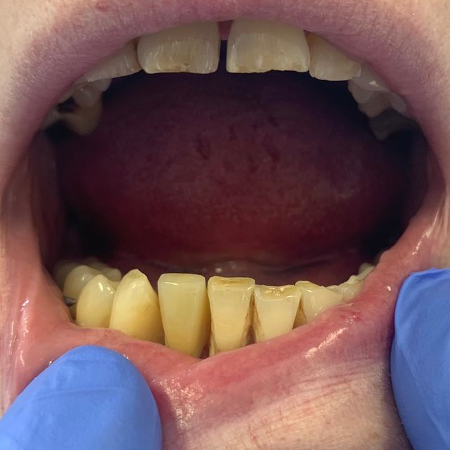 After: Parital Denture replacing missing tooth