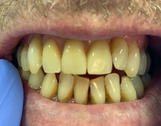 After, more nature looking dentures