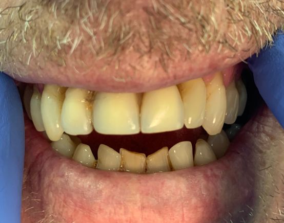 Before, Poor unrealistic upper dentures