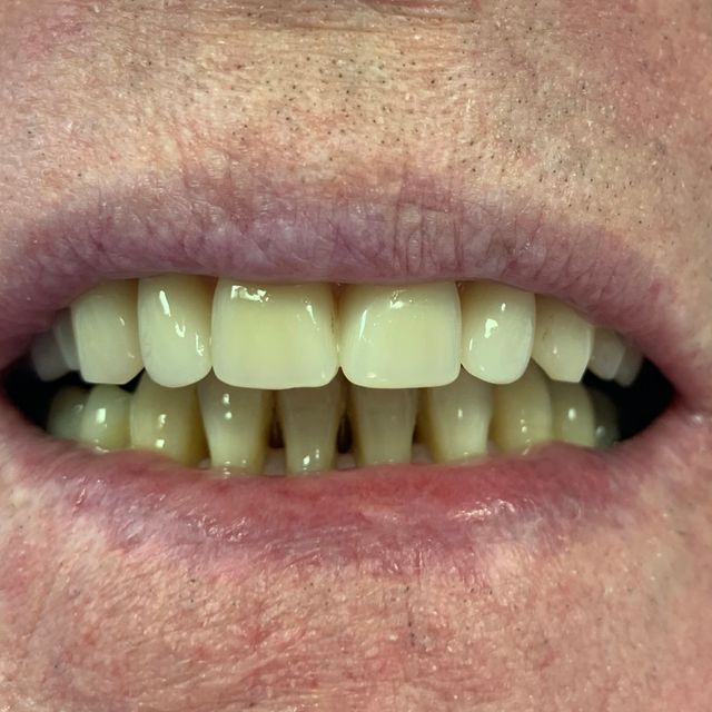 After Natural looking dentures