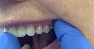  removable flexi partials