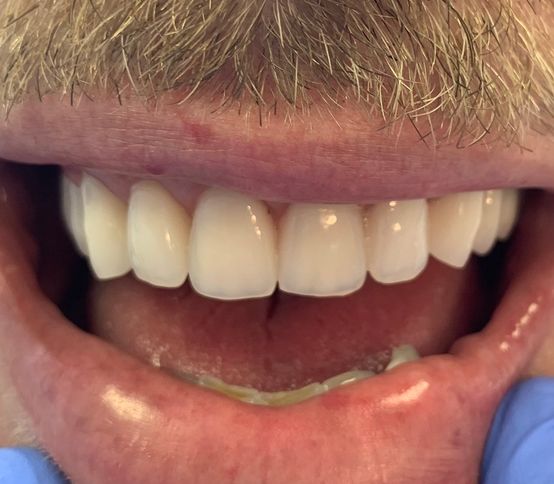 After, high quality realistic dentures 