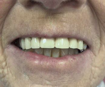 Before: Unrealistic looking upper dentures 