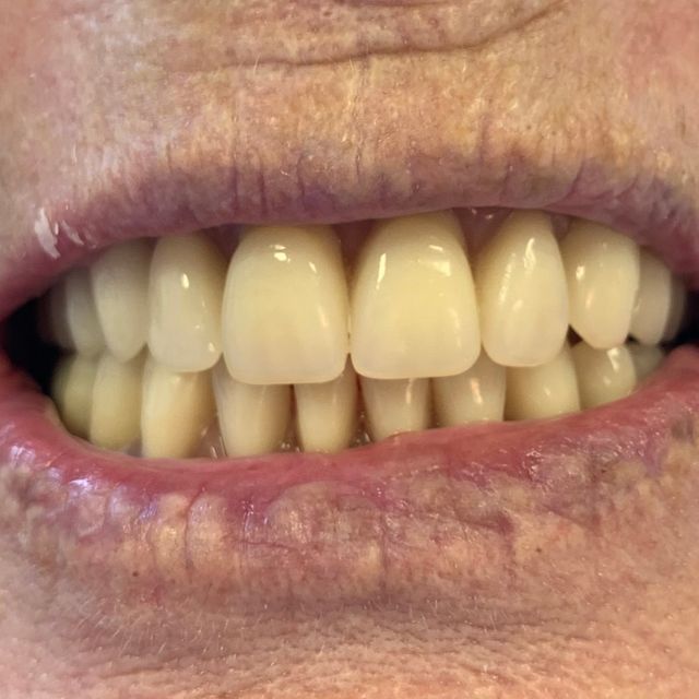 After Clean dentures