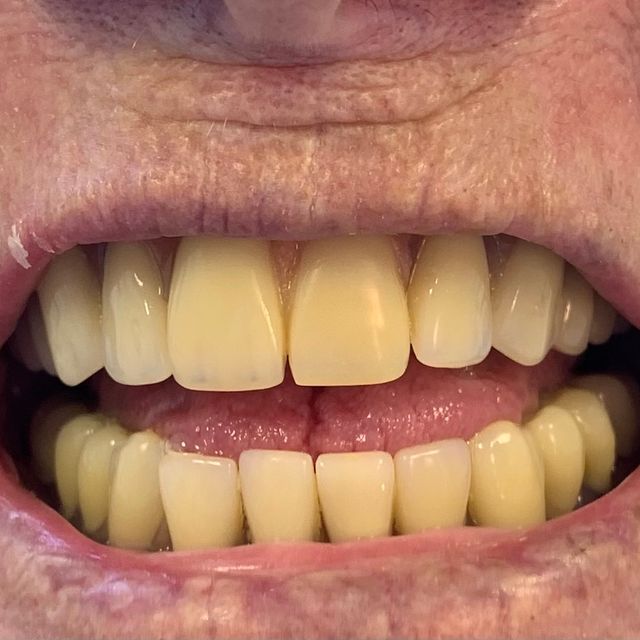 Before: Stained Dentures