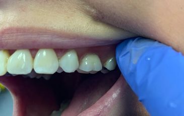 partial flexi replacing