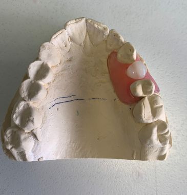  removable flexi partials