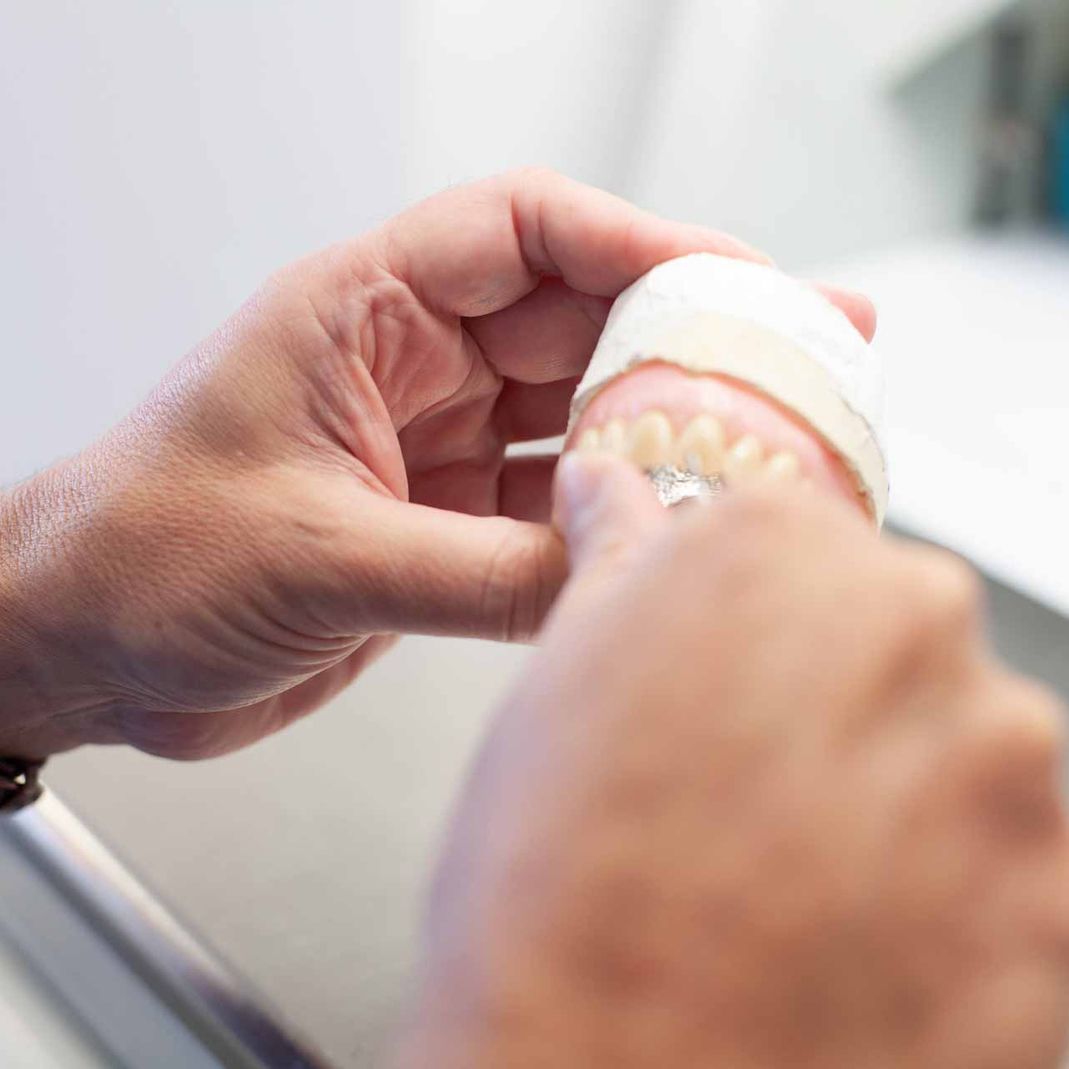 Dentist creating dentures for the upper jaw